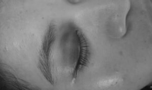 Kondisi Korban SL, mengalami memar di kelopak Mata setelah Dipukuli sang Pacar