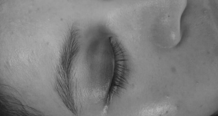 Kondisi Korban SL, mengalami memar di kelopak Mata setelah Dipukuli sang Pacar