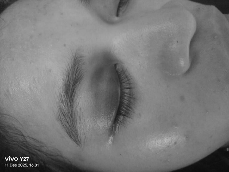 Kondisi Korban SL, mengalami memar di kelopak Mata setelah Dipukuli sang Pacar